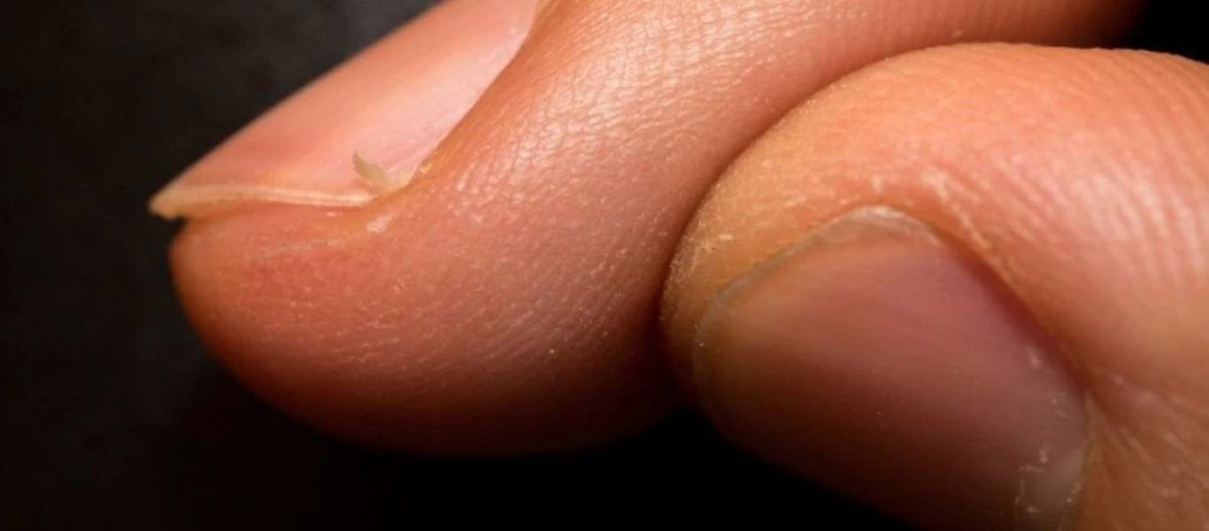 Παρωνυχίδα: Έτσι θα την αφαιρέσετε χωρίς πόνο και επιπλέον τραυματισμό